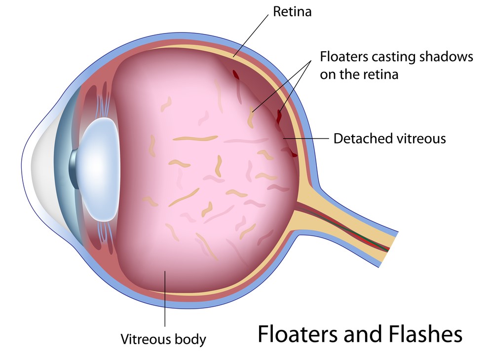 Flashes and Floaters in the eye